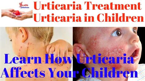 Urticaria Treatment Urticaria In Children Learn How Urticaria