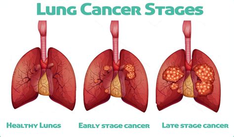Lung Cancer Types Treatments For Lung Cancer