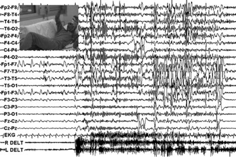 Early Myoclonic Encephalopathy Neonatal Myoclonic Encephalopathy