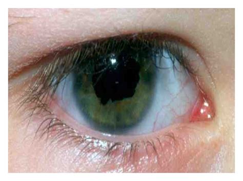 Right Eye At 4 Years Of Age Showing Congenital Ectropion Uvea 360
