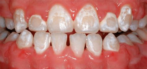 Interventions For Orthodontically Induced White Spot Lesions A