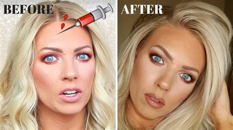 Botox My Experience Before And After Pictures Youtube