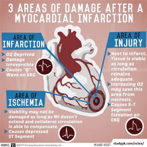 Nursing Infographics Areas Of Damage After Myocardial Infarction Studypk