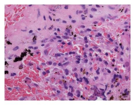 Histological Examination Showing The Metal Debris Histiocytes