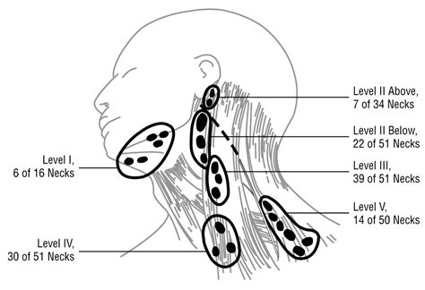 Tumor Above The Spinal Accessory Nerve In Papillary Thyroid Cancer That