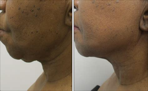 Plastic Surgery Neck Lift Before After Photos Chicago Face Lift