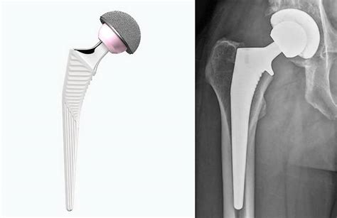 Hip Replacement Surgery Auld Orthopaedics Northampton