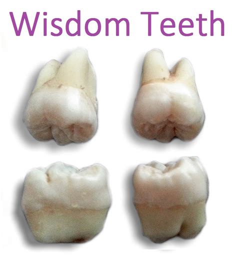 Wisdomteeth2018 Archer Dental
