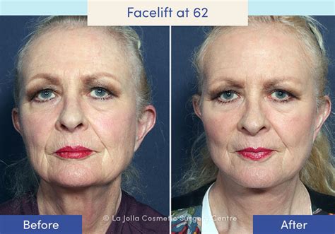 Facelift Before And After Photos What A Facelift Looks Like At 40 50