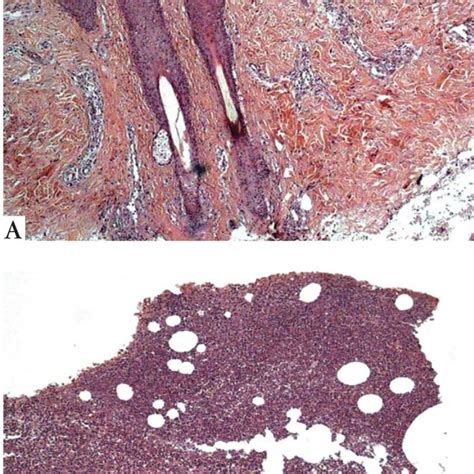 Ulcerative Pyoderma Gangrenosum Fig 2 Bullous Pyoderma Gangrenosum