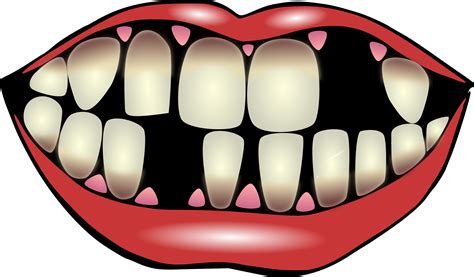 Clipart Of Teeth Affects And Pediatric Png Download Full Size