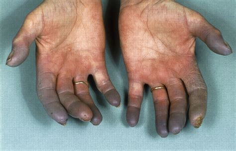 Diagnosis And Management Of Raynauds Phenomenon The Bmj