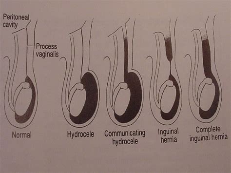 Hydrocele Inguinal Hernia