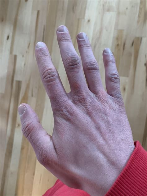 My Hands Are Turning Blue And Going Dark At The Knuckles Any Idea What