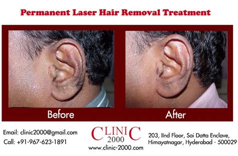 Laser Hair Removal For The Ears