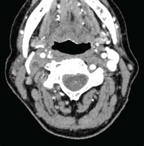 Axial Postcontrast Ct Image A Demonstrated The Presence Of Vascular
