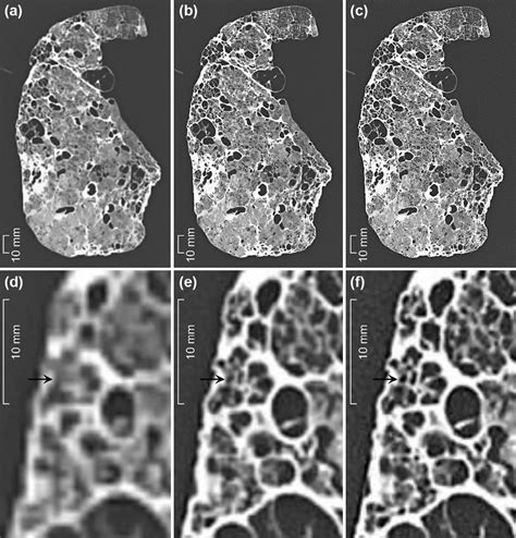 Ultra High Resolution Computed Tomography Images Of A Cadaveric Lung