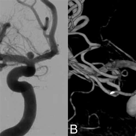Ruptured Middle Cerebral Artery Aneurysm In A 54 Year Old Woman A Ct