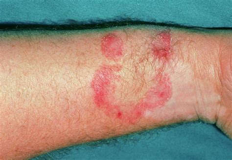 The Wrist Of A Patient Affected By Ringworm Photograph By Dr P Marazzi