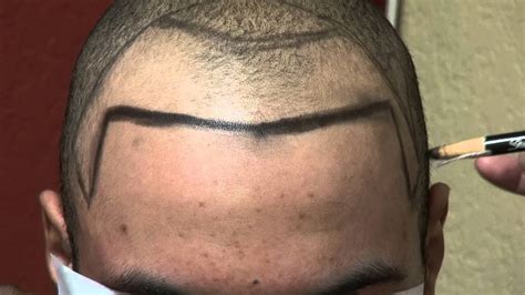 Receding hairline in men is a continuous process of hair loss that frequently starts from the forehead. Receding Hairline Man Transplant Treatment Los Gatos Near ...