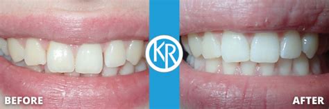 Invisalign Cosmetic Dentistry King Ritson Dental