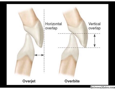 Overbite Overjet App App