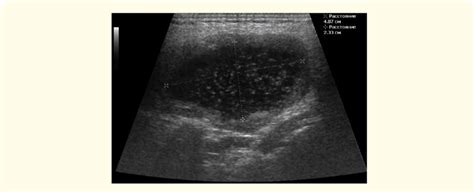Parotid Gland Abscess Ultrasound