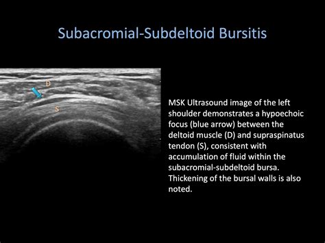 Subdeltoid Bursitis