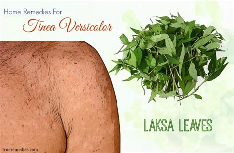35 Home Remedies For Tinea Versicolor On Back Treatment