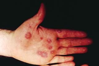 There are two types of hsv: Rash on palms and arms and blister on lower lip - The Clinical Advisor