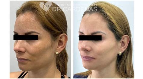 Rejuvenecimiento Facial En Costa Rica Dr Cárdenas Co2 Y Fotona