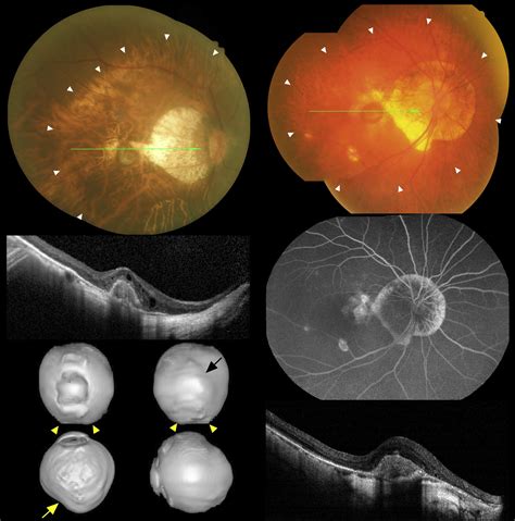 Clinical Characteristics Of Posterior Staphylomas In Myopic Eyes With