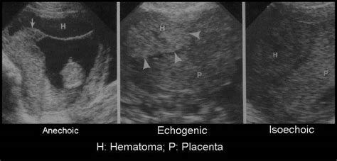 Placental Hematoma Ultrasound
