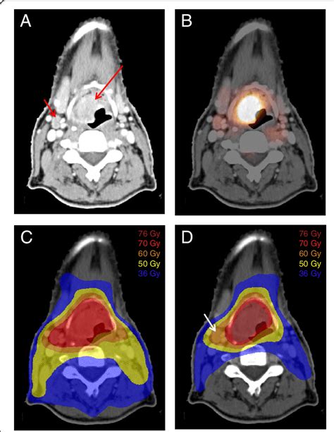 Radiation Therapy Planning Fdg Petct Scan Of A Patient With An