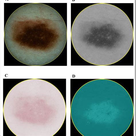 Images Of Melanocytic Naevus Mn Dermatoscopy A And Different