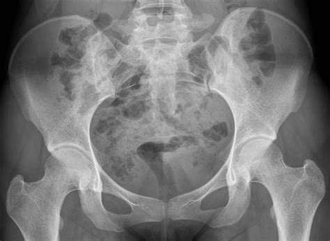 Normal Ap Pelvis X Ray Hot Sex Picture