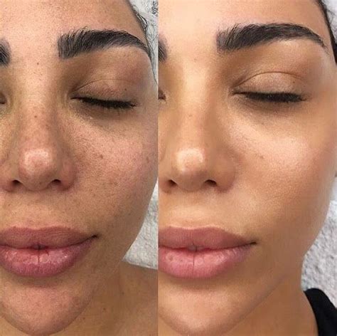 Facial Treatment Skin Treatments Facial Before And After Dermapen Microneedling Dermaroller