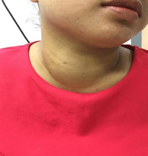 Diffuse Right Anterolateral Neck Swelling Which Developed Within 2 Days