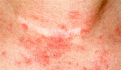 T Cell Lymphoma Skin Rash Cutaneous T Cell Lymphoma The Rashes Are