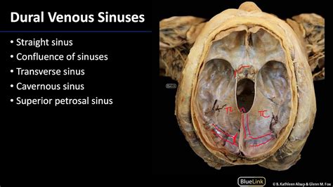 Cranial Cavity And Brain Dural Venous Sinuses YouTube