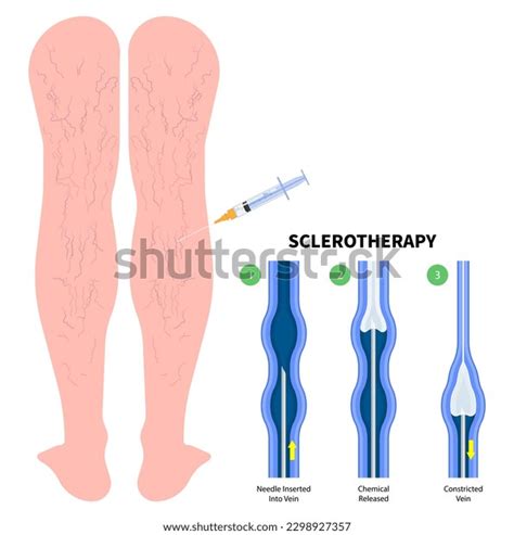 Injection Into Vein Photos And Images And Pictures Shutterstock