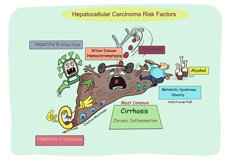 Hepatocellular Carcinoma Hcc Creative Med Doses