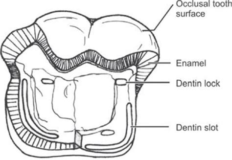 Fundamentals Of Tooth Preparation Part 2 Focus Dentistry