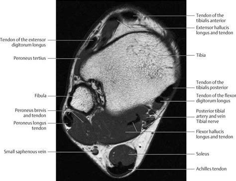 Muscles of the foot are located on its rear and on the sole. Ankle and Foot | Radiology Key