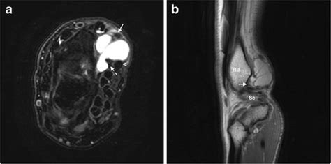 Ganglion Cyst In The Volar Aspect Of The Wrist In A 55 Year Old Woman