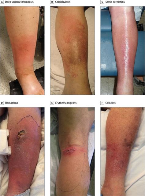 Cellulitis Is An Infection Of The Deep Dermis And Subcutaneous Tissue