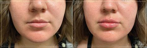 Juvederm Ultra And Ultra Plus In Irvine Under Eyes And Lips Filler