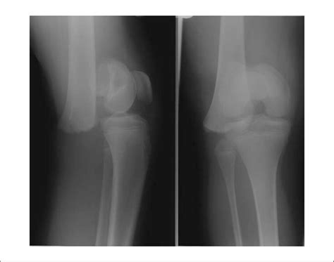 Ap And Lateral Radiographs Showing Sh 1 Fracture Of The Distal Femur