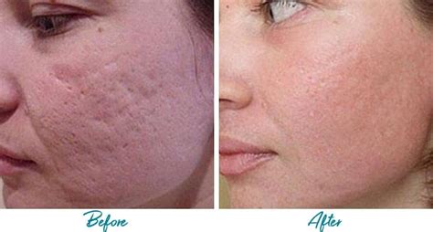 patient 18616225 acne scars before and after photos alinea medical spa acne scar and laser skin care