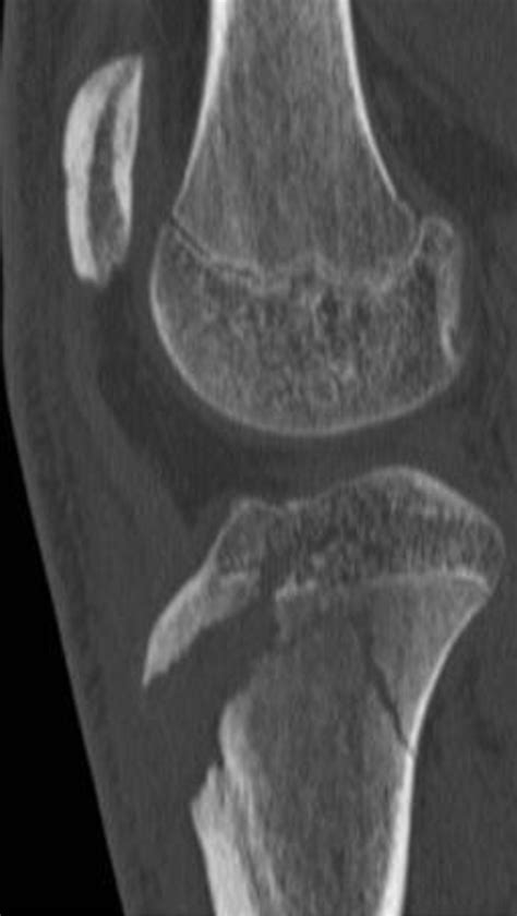 Imaging Review Of Adolescent Tibial Tuberosity Fractures